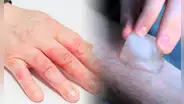¿Por qué no debo poner hielo en la piel si sufrí una quemadura y qué puedo colocar?