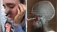 Joven se alistaba para conducir y termina con la llave del auto incrustada en su rostro