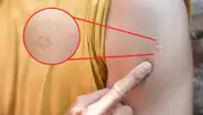¿Por qué la mayoría de personas tiene una pequeña marca en el brazo?