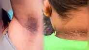 ¿Por qué me salen manchas oscuras en el cuello, axilas o entrepierna, y cómo eliminarlas?