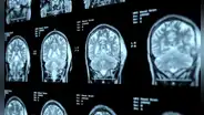 Médicos de China reportan un probable primer caso de alzheimer en paciente de 19 años