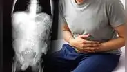 Hombre acude al hospital por dolor abdominal y encuentran tijeras quirúrgicas en su intestino