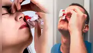 Por esta razón nunca debes inclinar tu cabeza hacia atrás cuando te sangra a nariz