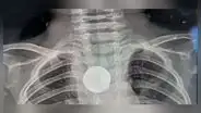 Niño de un año se traga una pila y sobrevive 5 semanas con el objeto atascado en su esófago