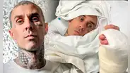 Travis Barker de Blink-182 tras cirugía en su dedo: "Fue un éxito, seguiré haciendo lo que me gusta"
