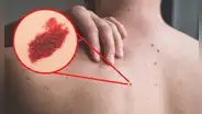 ¿Por qué algunas personas tienen lunares de sangre y qué tan peligrosos son?