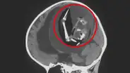 Médicos extraen un feto del cerebro de una bebé: se trata de su gemelo no nacido