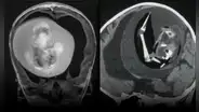 Un feto con columna vertebral y dedos fue extirpado del cerebro de una bebé de 1 año