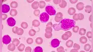 Píldora experimental consigue la remisión completa del cáncer en 18 pacientes con leucemia resistente