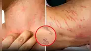 Piensa que tiene un simple sarpullido, pero en el hospital descubren gusanos debajo de su piel