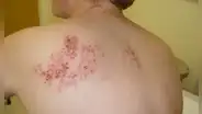 ¿Cómo es la 'segunda varicela', que aparece en 1 de cada 3 adultos?