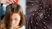 ¿Por qué algunos menores siempre tienen piojos, mientras que otros no, y cómo eliminarlos del cabello?