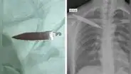 Médicos suturaron lesión a joven, pero le dejaron un cuchillo en la espalda por más de un mes