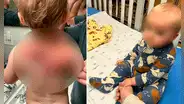 “Pequeña tortuga ninja”: el extraño caso del niño que nació con un ‘caparazón’ en la espalda