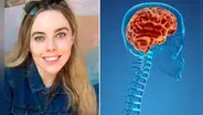 El curioso caso de Emily Balfour: rara condición hace que su cerebro se deslice por su columna