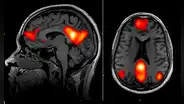 Inteligencia artificial puede detectar el Parkinson años antes de que aparezcan los síntomas