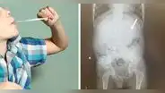 Niño tuvo que ser operado en EE. UU. tras tragarse 40 chicles y obstruir su sistema digestivo