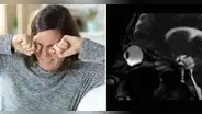 ¿Te rascas los ojos con frecuencia? Médicos muestran las peligrosas consecuencias