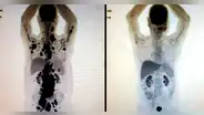 El antes y después de un paciente con cáncer que recibió prometedora terapia de células