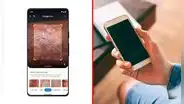 Google Lens podría ayudarte a detectar enfermedades en tu piel con la cámara de tu teléfono