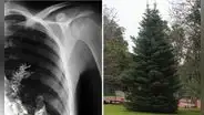 Fue al hospital por dolor de pecho y médicos hallaron parte de un árbol creciendo en su pulmón