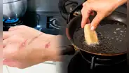 ¿Las quemaduras con aceite dejan cicatrices? Conoce cómo tratar estas heridas