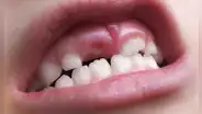Así funciona el fármaco experimental que podría regenerar los dientes caídos