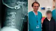 Médicos unen la cabeza al cuello de un niño que sufrió decapitación interna tras accidente