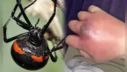 Niño queda grave tras dejarse picar por una araña viuda negra “para convertirse en Spiderman”
