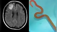 Médicos hallan un gusano vivo de 8 cm en el cerebro de una mujer en Australia