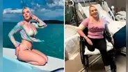 Modelo sufre amputación de una pierna tras contraer letal bacteria en sus vacaciones en Bahamas