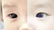 Color de ojos de bebé cambia tras recibir presunto fármaco contra la COVID-19