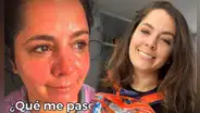 ¡Delicado! Yiddá Eslava sufre quemadura y preocupa a sus seguidores: ¿qué le pasó?
