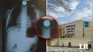Niño se traga moneda y no puede ser operado por falta de especialistas en hospital de Piura