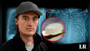Hombre que fumaba mucho recibe implantes mamarios para salvar su vida de enfermedad terminal