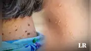 ¿Por qué me salen lunares de carne en el cuello o axilas y cómo eliminarlos? Especialistas lo explican
