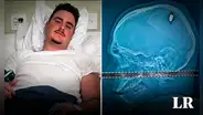 Joven estuvo de fiesta por 4 días con una bala en la cabeza: pensó que era un simple golpe