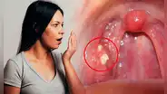 ¿Por qué me salen bolitas amarillas en la garganta y cómo puedo eliminarlas para no tener mal aliento?