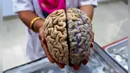 Estudio sugiere que un tratamiento hormonal transmitió el alzheimer a personas sanas y jóvenes