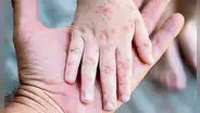 El sarampión reaparece por los antivacunas