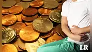 Hombre se salva de morir tras ingerir 39 monedas y 37 imanes: decía que "el zinc ayuda en el culturismo"