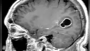 Médicos en EE. UU. encuentran larvas en el cerebro de hombre con migrañas