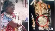 Mujer descubre que tenía un feto calcificado desde hace 56 años: murió tras operación