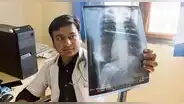 Cada año se reportan 30 mil casos de tuberculosis en el Perú