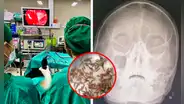 Mujer descubre 100 larvas dentro de su nariz cuando pensaba que tenía una simple congestión nasal