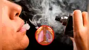 Joven sufre colapso pulmonar por uso excesivo de cigarros electrónicos: desarrolló una ampolla en el pulmón