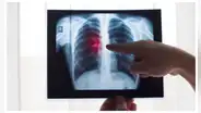 OMS: Fumar provoca hasta veinte tipos de cáncer