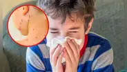 Perú en alerta por 'bacteria asesina' que alarmó a diversos países del mundo: ¿Cómo prevenirla y cuáles son sus síntomas?