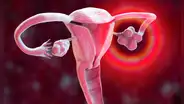 Científicos descubren método para detectar el cáncer de ovario 4 años antes de su diagnóstico