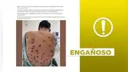 Foto no muestra "primer caso de viruela del mono fuera de África" reportado por Suecia en 2024